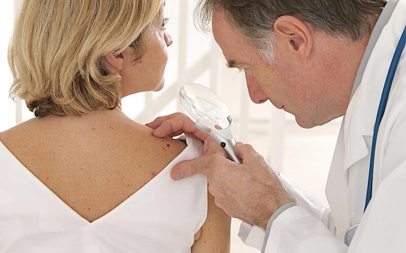 A woman with papilloma is seen by a doctor before taking Removio gel