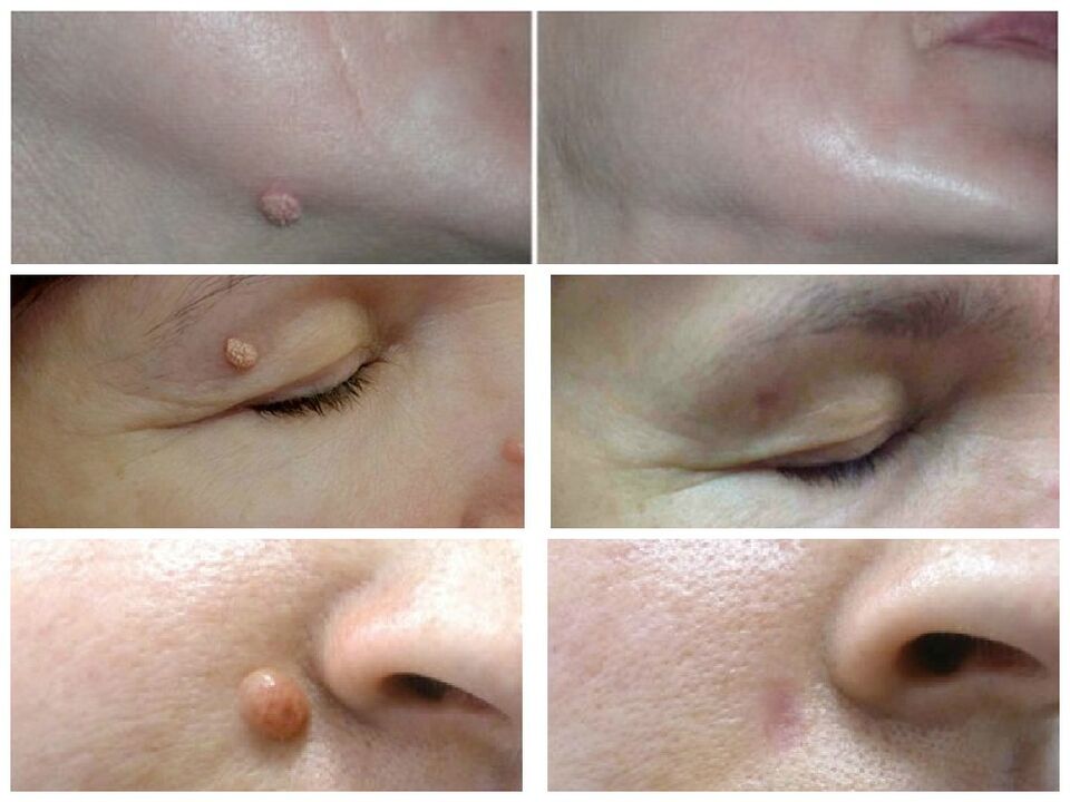 Successful removal of warts after reviewing Rimovio gel from Andrew 1
