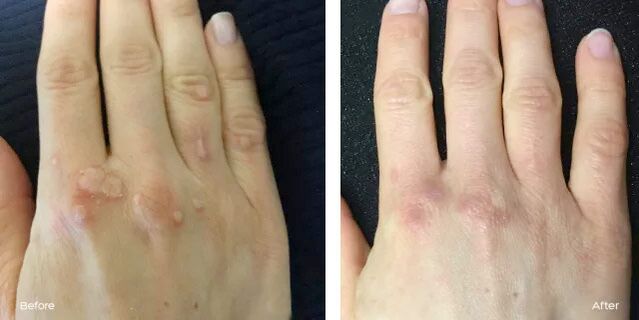 Successful removal of warts after reviewing Rimovio gel from Andrew 2