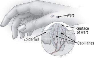 The structure of the wart in hand