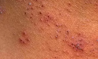 multiple papillomas on the skin