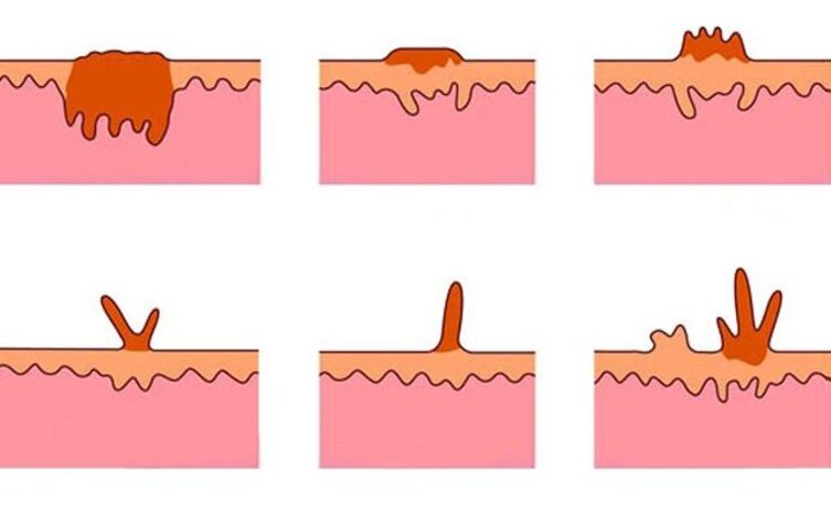 types of papilloma