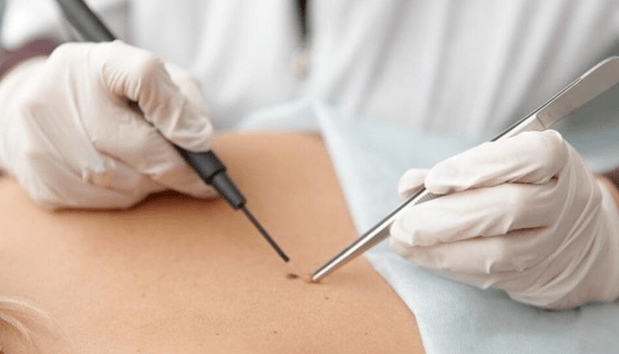 Features of the removal of the papilloma
