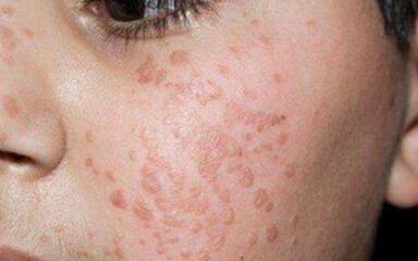 Flat papiles on their face