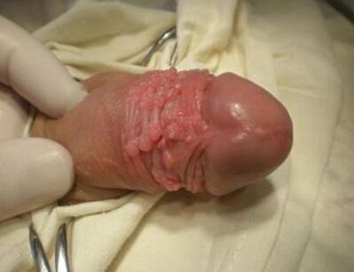 Papilloma at a member