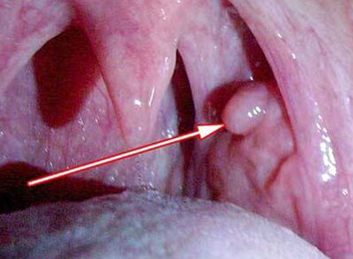 Papilloma in Laryng