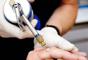 Methods to remove skin papillomas