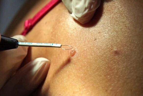 removal of body warts