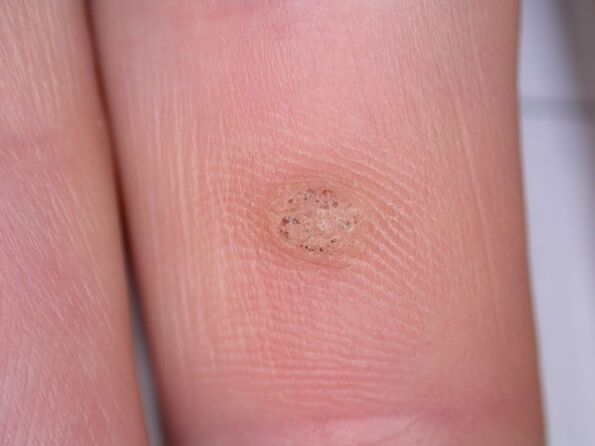 warts can cause cancer