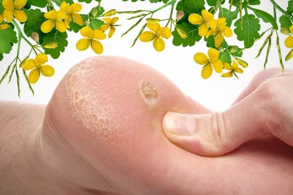 warts treatment methods