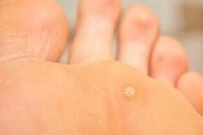 Why do plantar warts appear