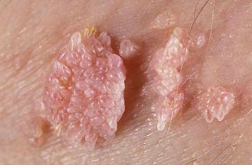What do genital papillomas look like
